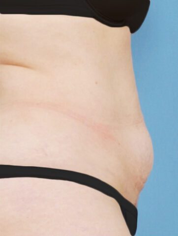 Case # 17 before photo