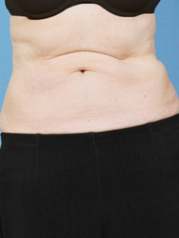 Case # 21 after photo