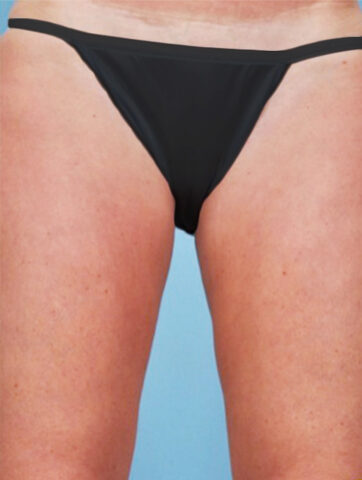 Case # 19 after photo