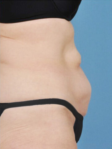 Case # 15 after photo