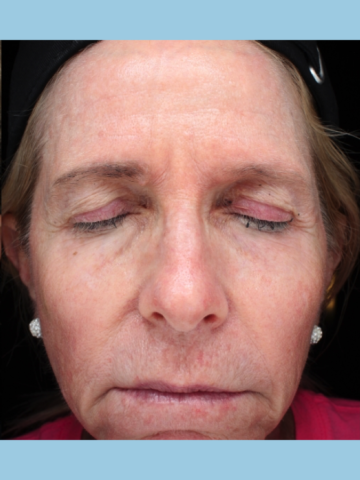 Case # 15 after photo