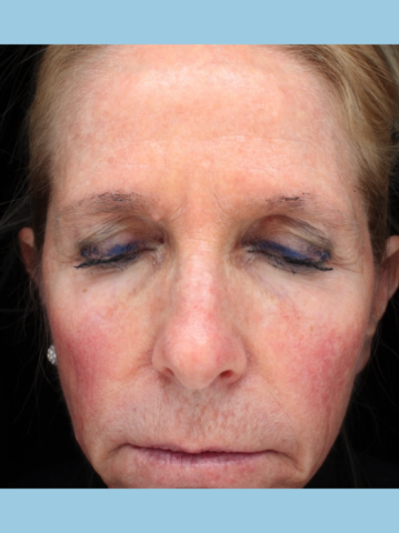 Case # 15 before photo