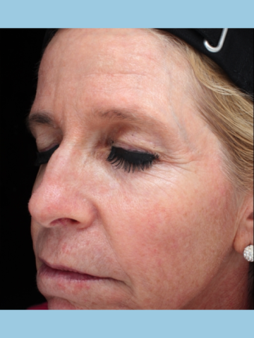 Case # 15 after photo