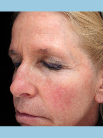 Case # 15 before photo