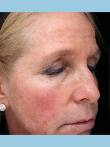 Case # 15 before photo