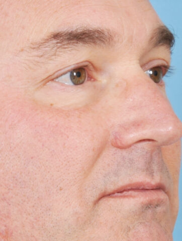 Case # 14 after photo