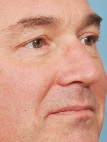 Case # 14 before photo