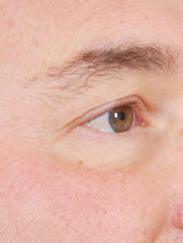 Case # 14 after photo