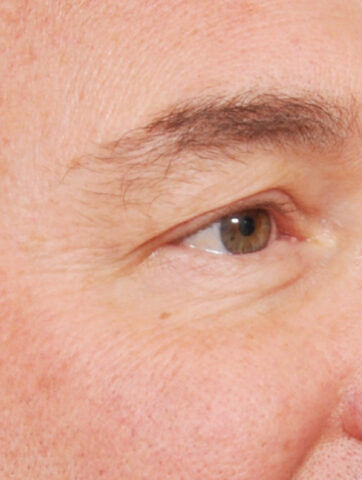 Case # 14 before photo