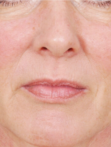 Case # 13 after photo