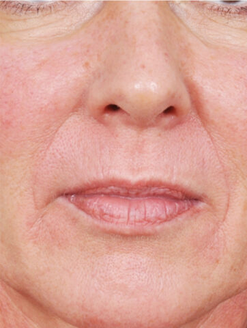 Case # 13 before photo