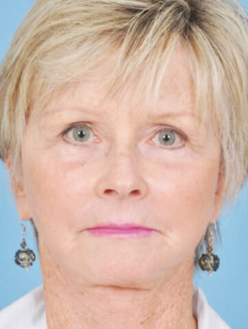 Case # 12 after photo