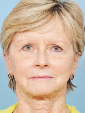 Case # 12 before photo