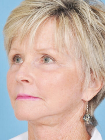 Case # 12 after photo