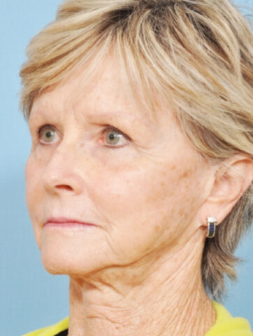 Case # 12 before photo