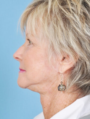 Case # 12 after photo