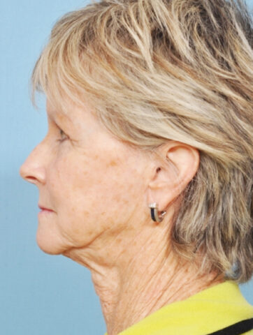 Case # 12 before photo