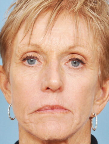 Case # 11 after photo