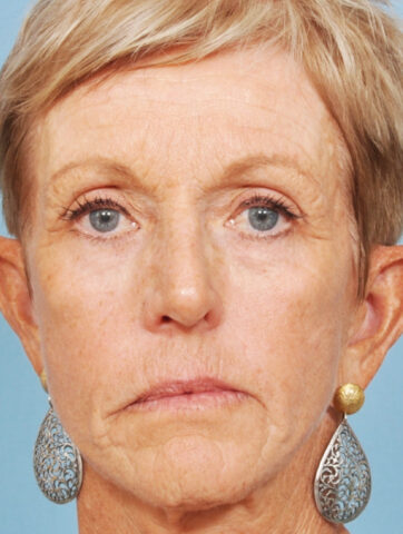 Case # 11 before photo