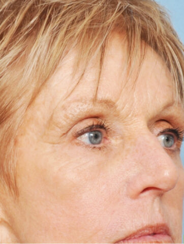 Case # 11 after photo