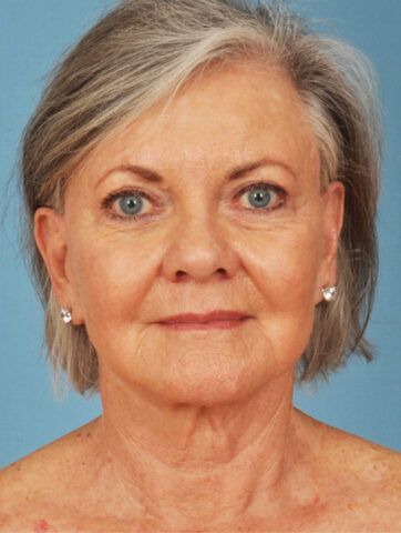 Case # 9 after photo