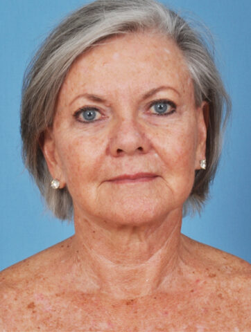 Case # 9 before photo