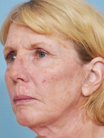 Case # 8 after photo