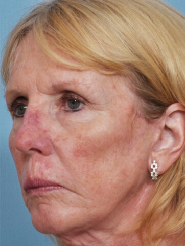 Case # 8 before photo