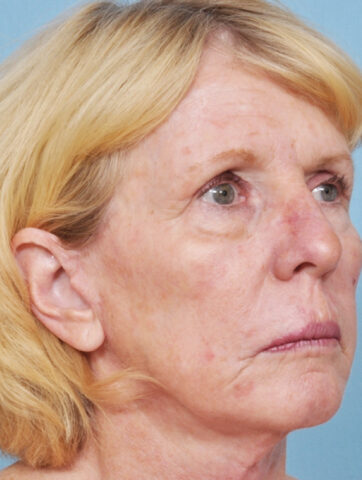 Case # 8 after photo