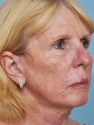 Case # 8 before photo