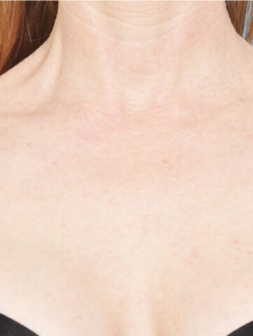 Case # 4 after photo