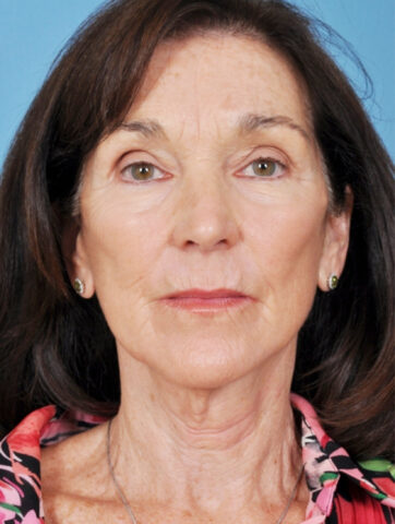 Case # 3 after photo