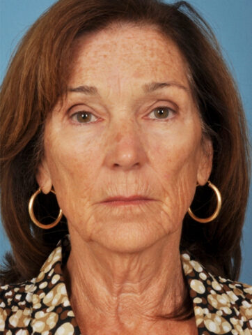 Case # 3 before photo