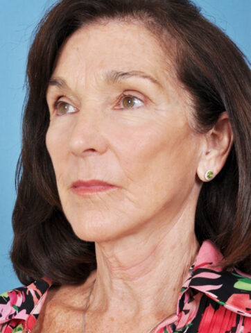 Case # 3 after photo