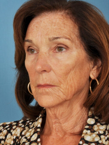 Case # 3 before photo