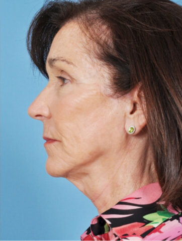 Case # 3 after photo