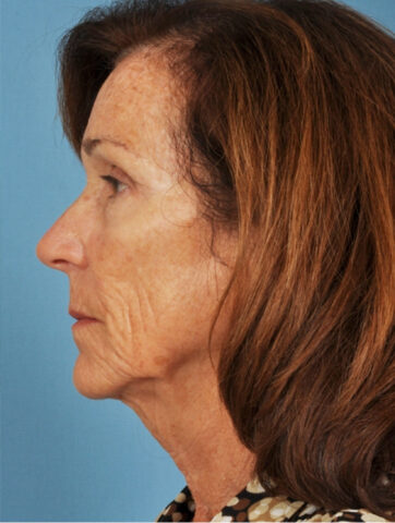 Case # 3 before photo