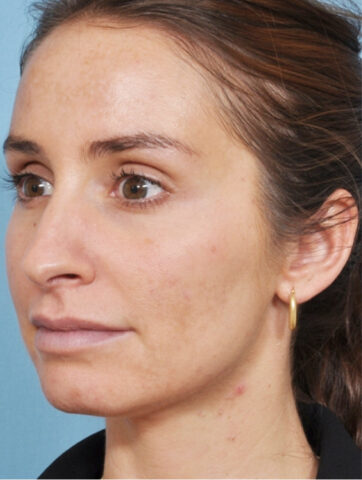 Case # 1 after photo