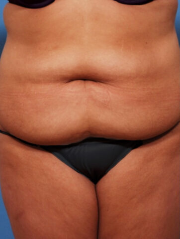 Case # 3 before photo