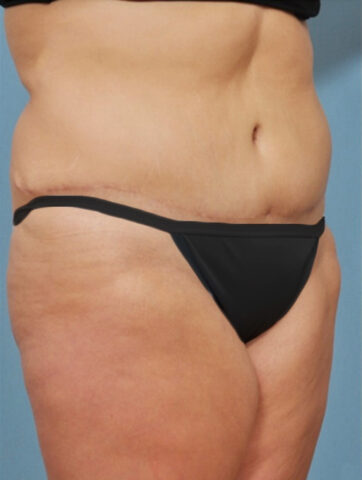 Case # 3 after photo