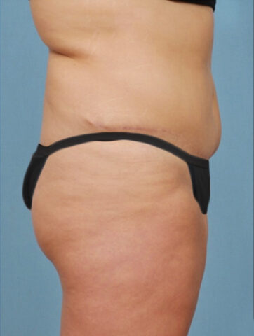 Case # 3 after photo