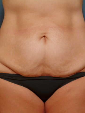 Case # 5 before photo