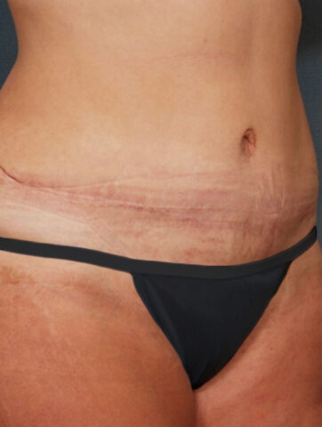 Case # 5 after photo