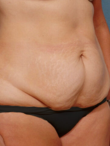 Case # 5 before photo