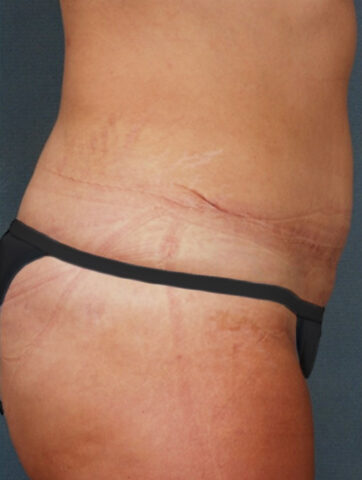 Case # 5 after photo