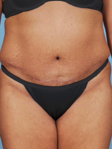 Case # 4 after photo