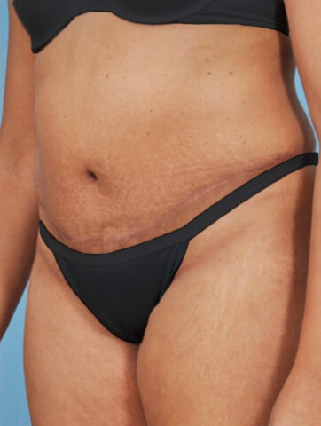 Case # 4 after photo