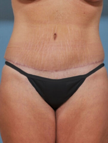 Case # 2 after photo