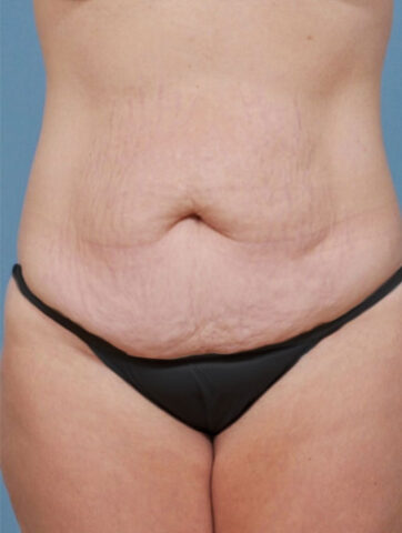 Case # 2 before photo