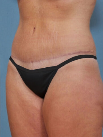 Case # 2 after photo